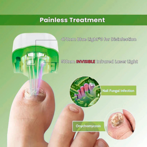 Homzgear™ - Nail Fungus Laser