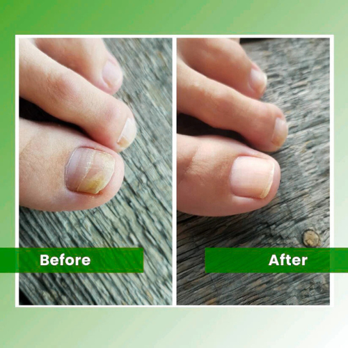 Homzgear™ - Nail Fungus Laser