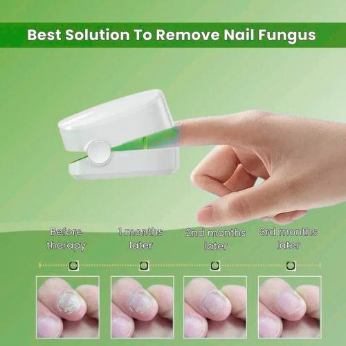 Homzgear™ - Nail Fungus Laser